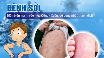 Thủ tướng Chính phủ chỉ đạo tăng cường công tác phòng, chống bệnh sởi