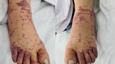 Butcher បានឆ្លងមេរោគ streptococcus suis