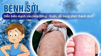 Prime Minister requests to strengthen measles prevention and control