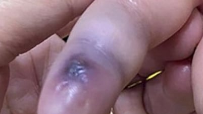 Phú Quốc: Cứu sống 2 trường hợp bị rắn lục đuôi đỏ cắn