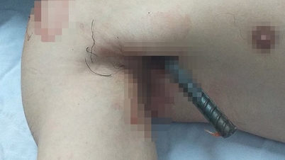 Surgery to save young man impaled by 2 iron bars