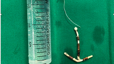 IUD ចូលទៅក្នុងប្លោកនោម