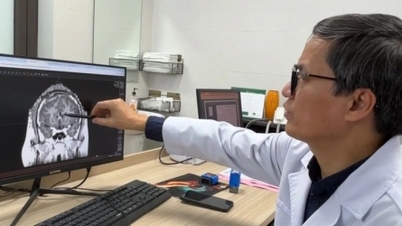 Wunderoperation reduziert 90 % der epileptischen Anfälle nach 21 Jahren Leiden