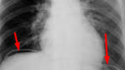 Exam pressure can increase stomach diseases