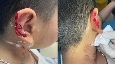 Bị chó lạ Phú Quốc vồ cắn, tai bé trai thương tích biến dạng