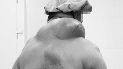 Drinking alcohol for many years, male patient carries a fatty tumor on the back of the neck weighing nearly 1.5kg