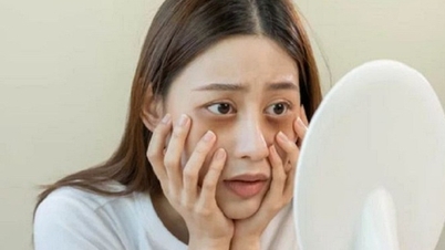 Mắt quầng thâm, khi nào là dấu hiệu cần đi bác sĩ khám?