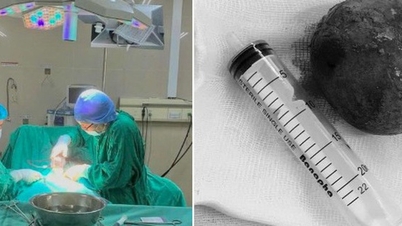 Riesiger Stein in der Blase eines 34-jährigen Mannes in Ninh Binh entdeckt