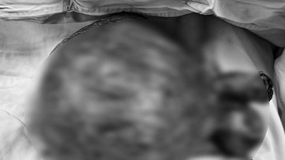 Successfully removed nearly 3kg fibroid tumor in patient's abdomen