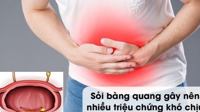 Người đàn ông 49 tuổi ở Phú Thọ nguy cơ suy thận do sỏi bàng quang gây tắc nghẽn đường tiểu