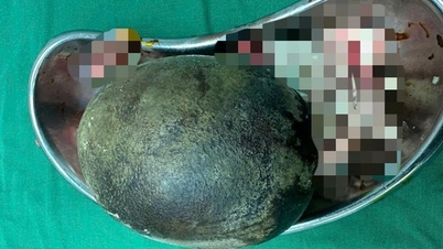 45-jähriger Mann trägt 700 Gramm schweren Blasenstein mit sich herum, eine Krankheit, an der viele Vietnamesen häufig leiden