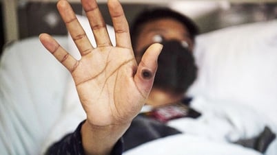 Việt Nam luôn chủ động ứng phó với bệnh đậu mùa khỉ