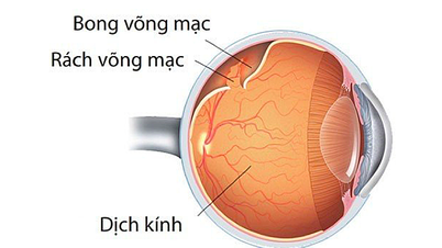 Mù một mắt sau một tháng bong võng mạc