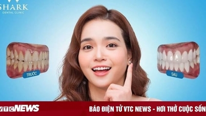 50% discount on porcelain veneers at Shark Dental Clinic