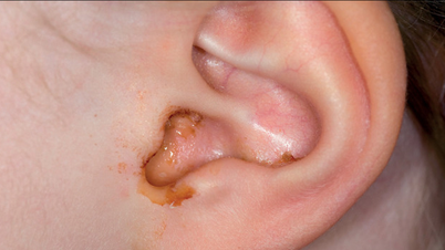 តើប្រព័ន្ធផ្សព្វផ្សាយ otitis ស្រួចស្រាវមានគ្រោះថ្នាក់ដល់កុមារដែរឬទេ?