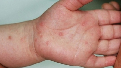 Be careful with hand, foot and mouth disease in children