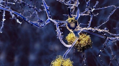 Second person in the world discovered to have gene that can resist Alzheimer's disease