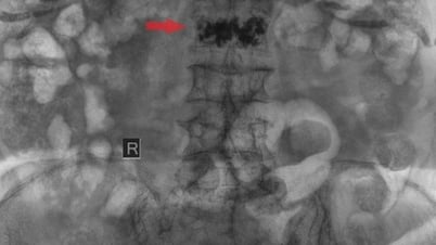 Bio-cement injection saves 100-year-old woman from falling and spinal injury