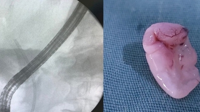 Endoscopy to remove 'giant' liver fluke from patient's bile duct