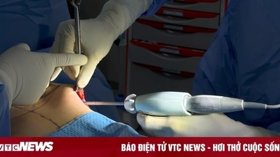 Kỹ thuật tạo khoang đúng với kích cỡ túi ngực trong nâng ngực
