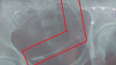Bác sĩ mổ nhầm bệnh nhân