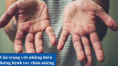 ប្រយ័ត្ន​កើត​ជំងឺ​ដៃ ជើង និង​មាត់​ចំពោះ​កុមារ!