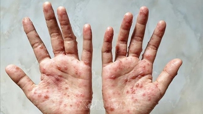 TP HCM: Một lúc đối phó với 5 dịch bệnh, số ca đậu mùa khỉ tăng