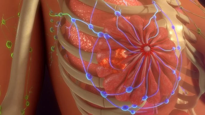 Trouver une solution optimale pour le traitement du cancer du sein, le tamoxifène