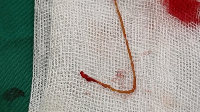 Mujer con cálculos biliares y absceso hepático debido a una infección parasitaria.