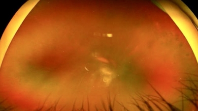 Pemeriksaan retina percuma untuk pesakit diabetes menggunakan teknologi AI
