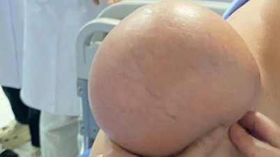 Egy férfi 5 éve hordoz egy óriási daganatot a vállán