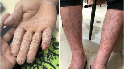 الأمراض الجلدية الشائعة بعد الفيضانات