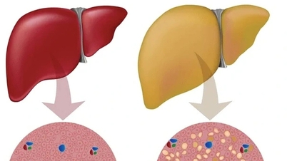 Quem é suscetível à doença hepática gordurosa?