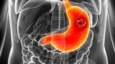 Läkare rekommenderar kost för att förebygga magcancer