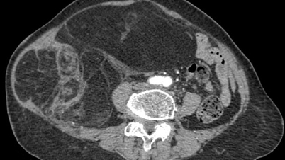 Perut wanita tua itu luar biasa besar dan tegang, pakar bedah membuang tumor malignan seberat hampir 4kg.