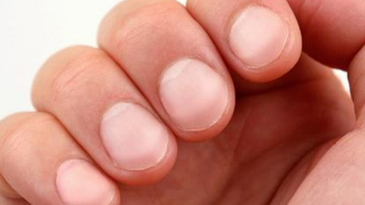 5 dấu hiệu trên móng tay có thể tiết lộ tình trạng sức khỏe của người nhiễm HIV
