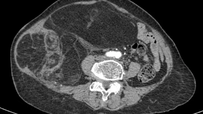 Kirurgi för att ta bort ett liposarkom som väger nästan 4 kg hos en 76-årig patient