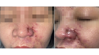 Orbire, embolie, infecție, necroză a pielii din cauza unor tratamente cosmetice nesigure