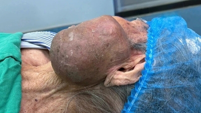 Cắt bỏ khối u khổng lồ trên mặt bệnh nhân 99 tuổi