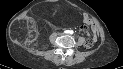 Succesvolle operatie aan een kwaadaardige tumor van bijna 4 kg bij een patiënt