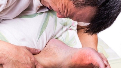 পায়ের তলা জ্বালাপোড়া কোন রোগের লক্ষণ?