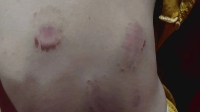 স্কুলের পর ৩ বছর বয়সী মেয়েটির শরীরে অনেক আঘাত এবং দাঁতের চিহ্ন রয়েছে