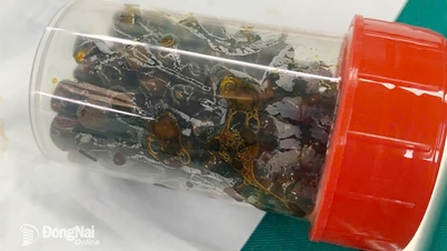 ניתוח לפרוסקופי להסרת יותר מ-100 אבני מרה