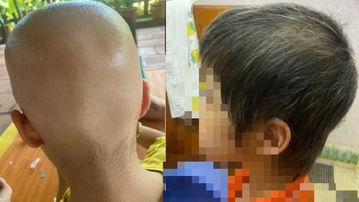 Bé gái 7 tuổi rụng hết tóc bất ngờ mọc kín đầu sau một năm