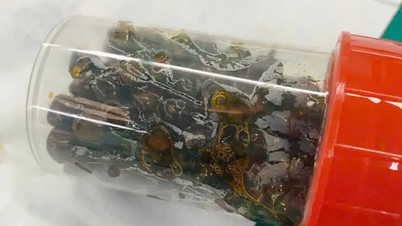 ការវះកាត់យកគ្រួសក្នុងថង់ទឹកប្រមាត់ជាង 100 ចេញពីថង់ទឹកប្រមាត់របស់ស្ត្រី