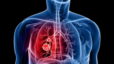 Trí tuệ nhân tạo mở ra kỳ vọng mới cho sàng lọc ung thư phổi