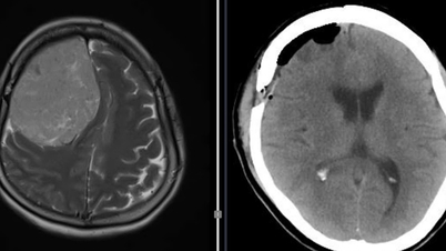 صداع وضعف في نصف الجسم، كشف الفحص الطبي عن وجود ورم سحائي يزن 600 جرام.