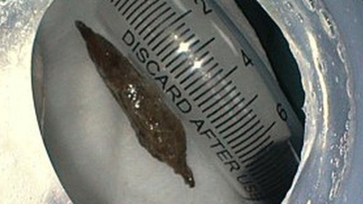 Eating bird's nest porridge, woman suddenly had red apple seeds pierce her stomach wall