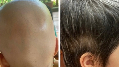 Πολλοί νέοι χάνουν ξαφνικά τα μαλλιά τους.