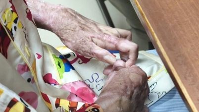 دختر ۱۷ ساله ای که تمام بدنش با چسب شمع سوخته بود، مجبور به ۱۵ عمل جراحی شد